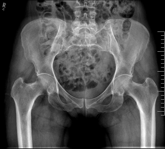 stress-fractures-the-bone-school